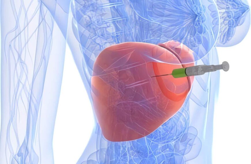 Adelantos Científicos y Técnicos* : Hemangioma Cavernoso del Hígado