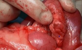 Sepsis Abdominal, El Problema Clinicopatológico