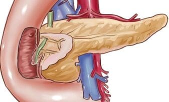 Tratamiento del Insulinoma