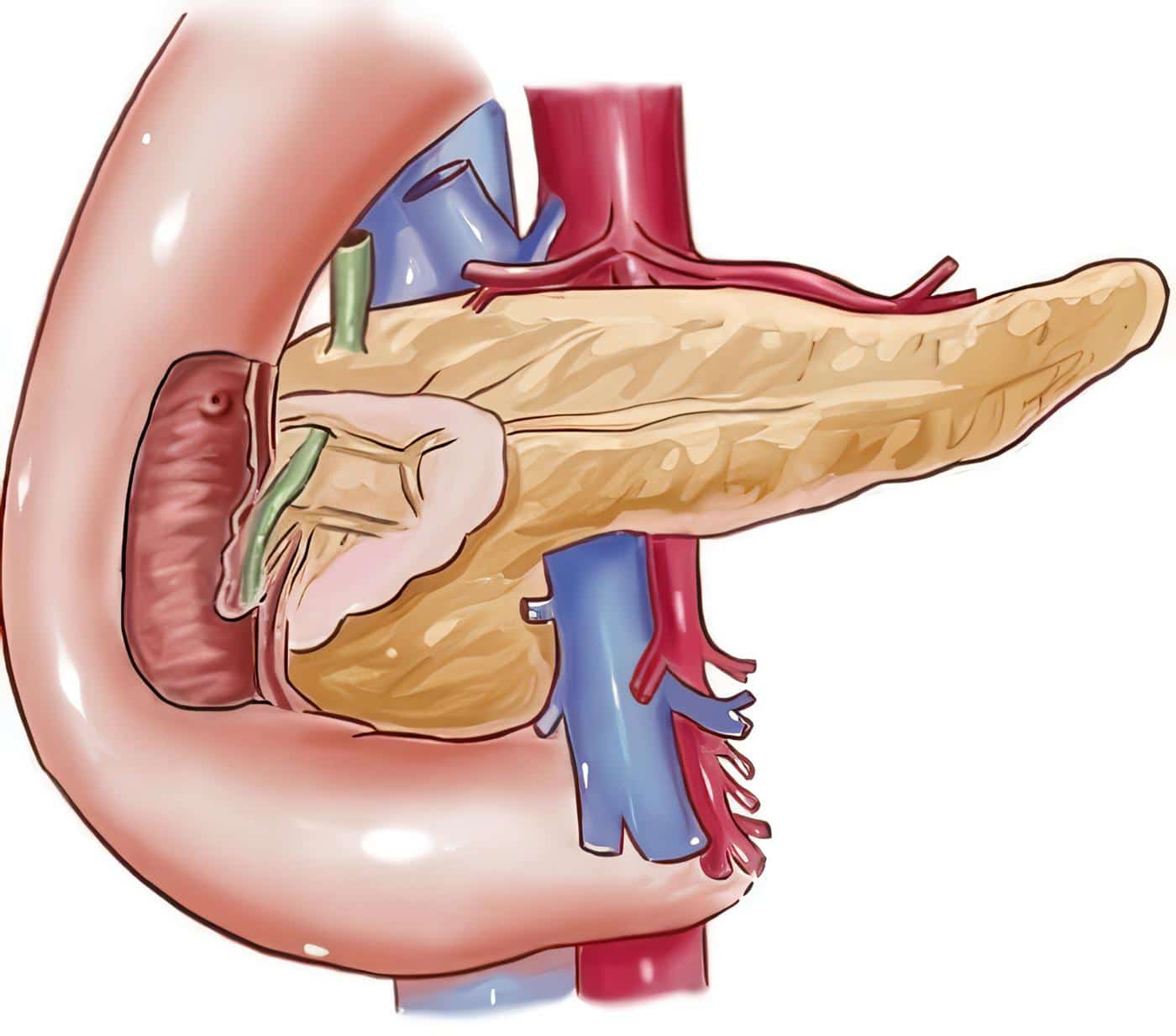 Tratamiento del Insulinoma