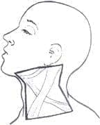 Disección radical de cuello