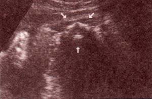 Diagnóstico Prenatal - tercer trimestre corte transversal. 36 semanas