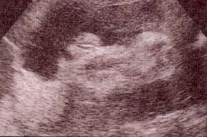 Diagnóstico Prenatal -  genitales externos xx