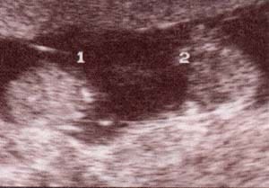 Diagnóstico Prenatal -  abdomen en embarazo bicorial - biamniótico.