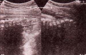 Espina Bifida - Mielomeningocele