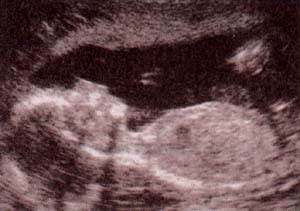 En el segundo trimestre es posible aún obtener una visión en conjunto del feto