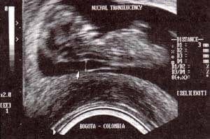  Imagen ecográfica de un feto de 12 semanas con translucencia nucal de 3.0mn afecto de trisomía 21.