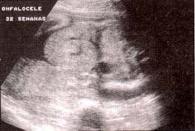 Onfalocele en un feto afecto de trisoma 13
