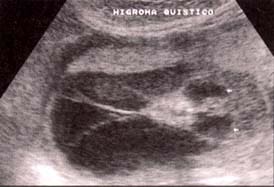 Higroma quístico en un feto con síndrome de Turner