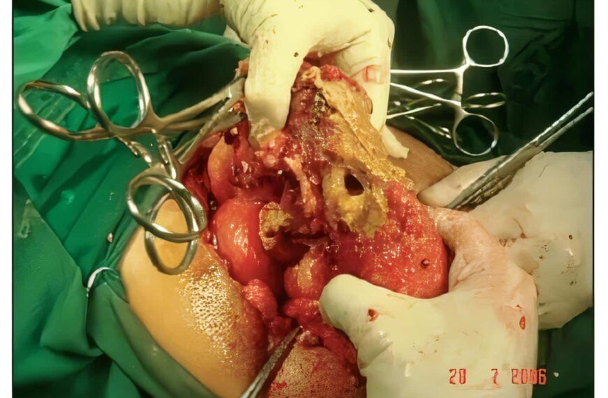 Revisión de Temas: Sepsis Abdominal