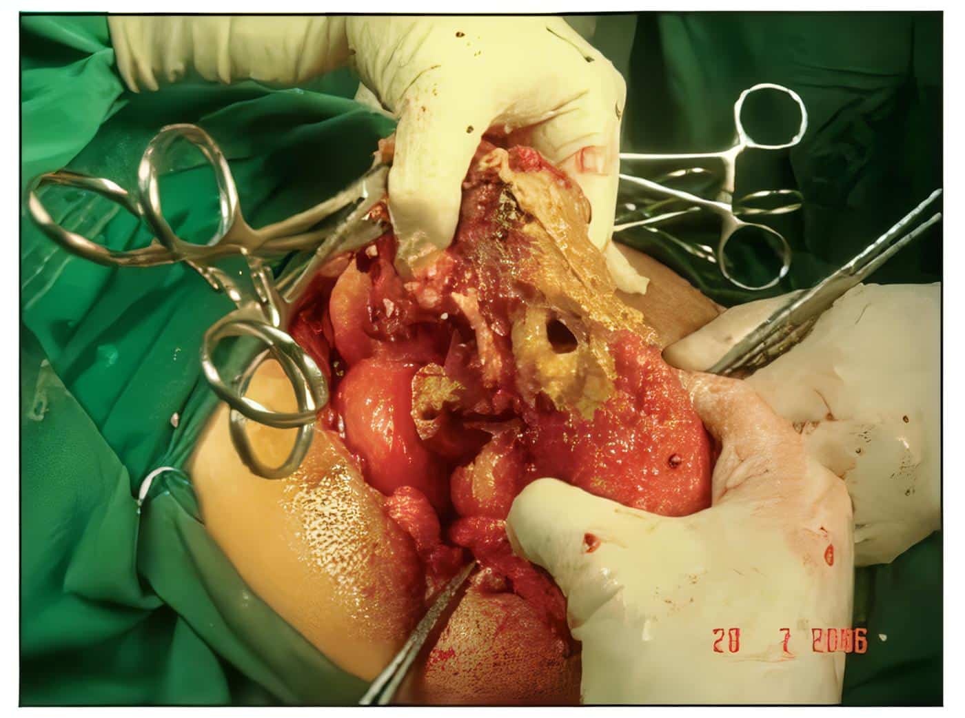 Revisión de Temas: Sepsis Abdominal