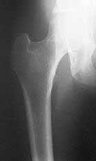 Radiografía de cuello de fémur osteoporótico