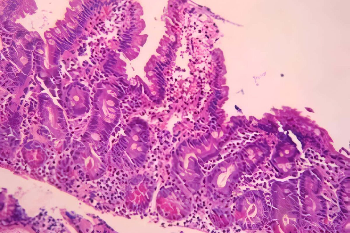 Neumatosis Intestinal