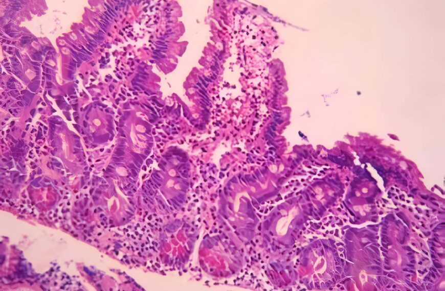 Neumatosis Intestinal