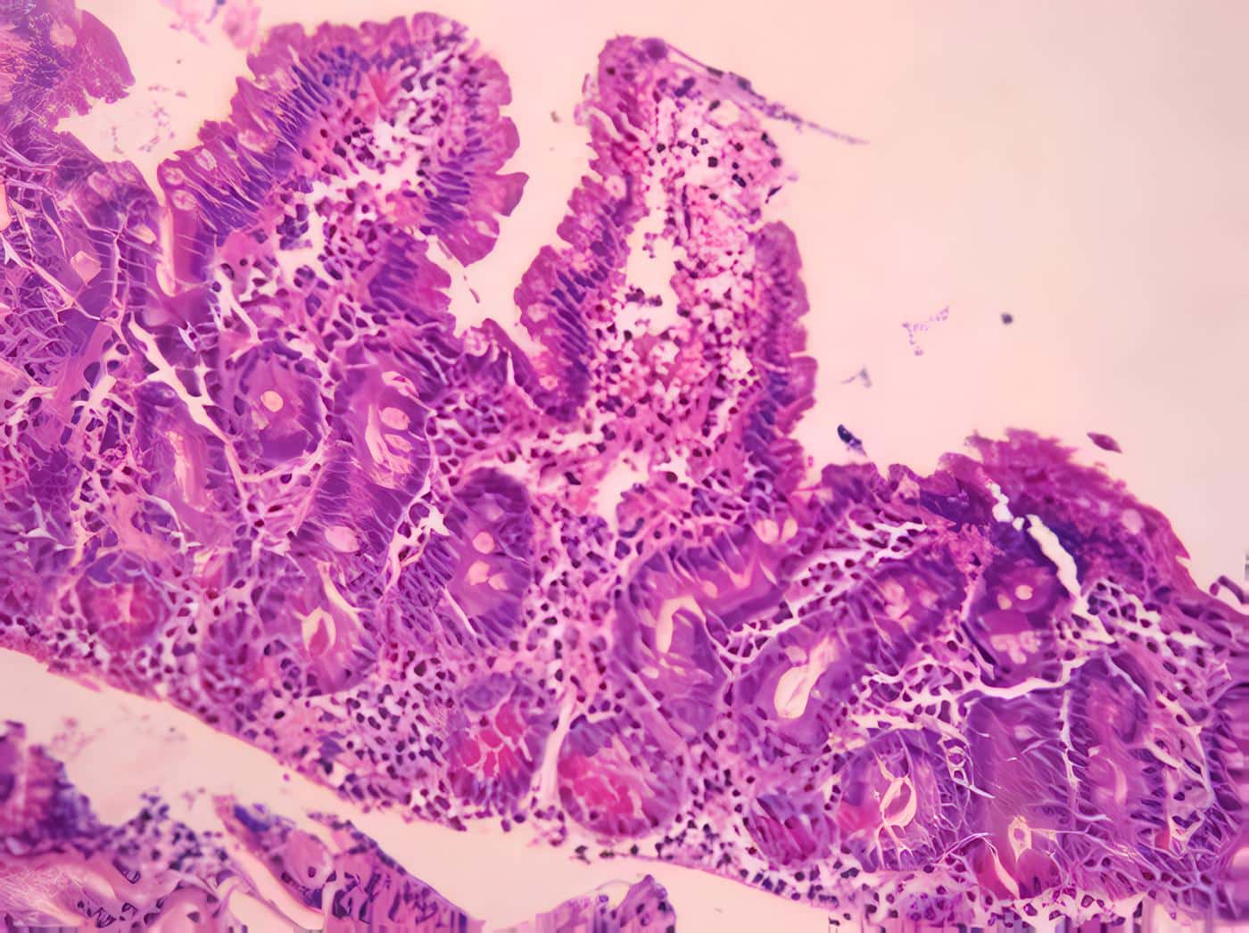 Neumatosis Intestinal