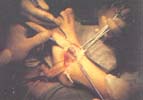 Cirugía reconstructiva: Liberación dorsoexterna