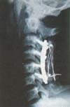 Radiografía lateral postquirúrgica