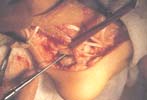 Capsulotomía Posterior