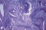 vol102- Histopatología en tejido fibroso inmaduro2