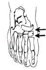 Capsulomia escafo cuneana metatarsiana