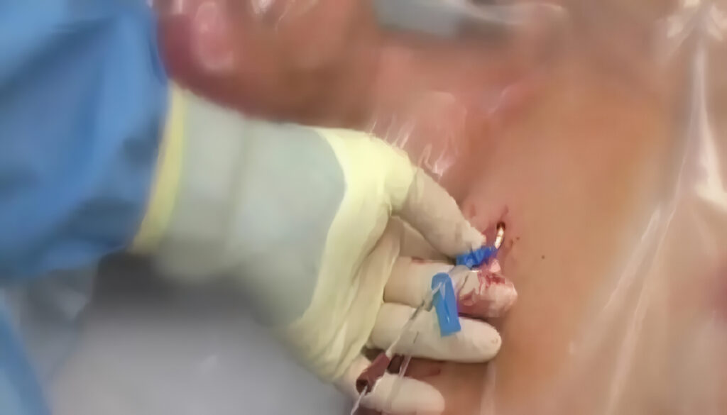 Infecciones Intravasculares