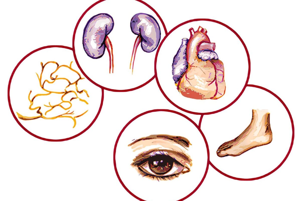 Complicaciones Micro Vasculares de la Diabetes