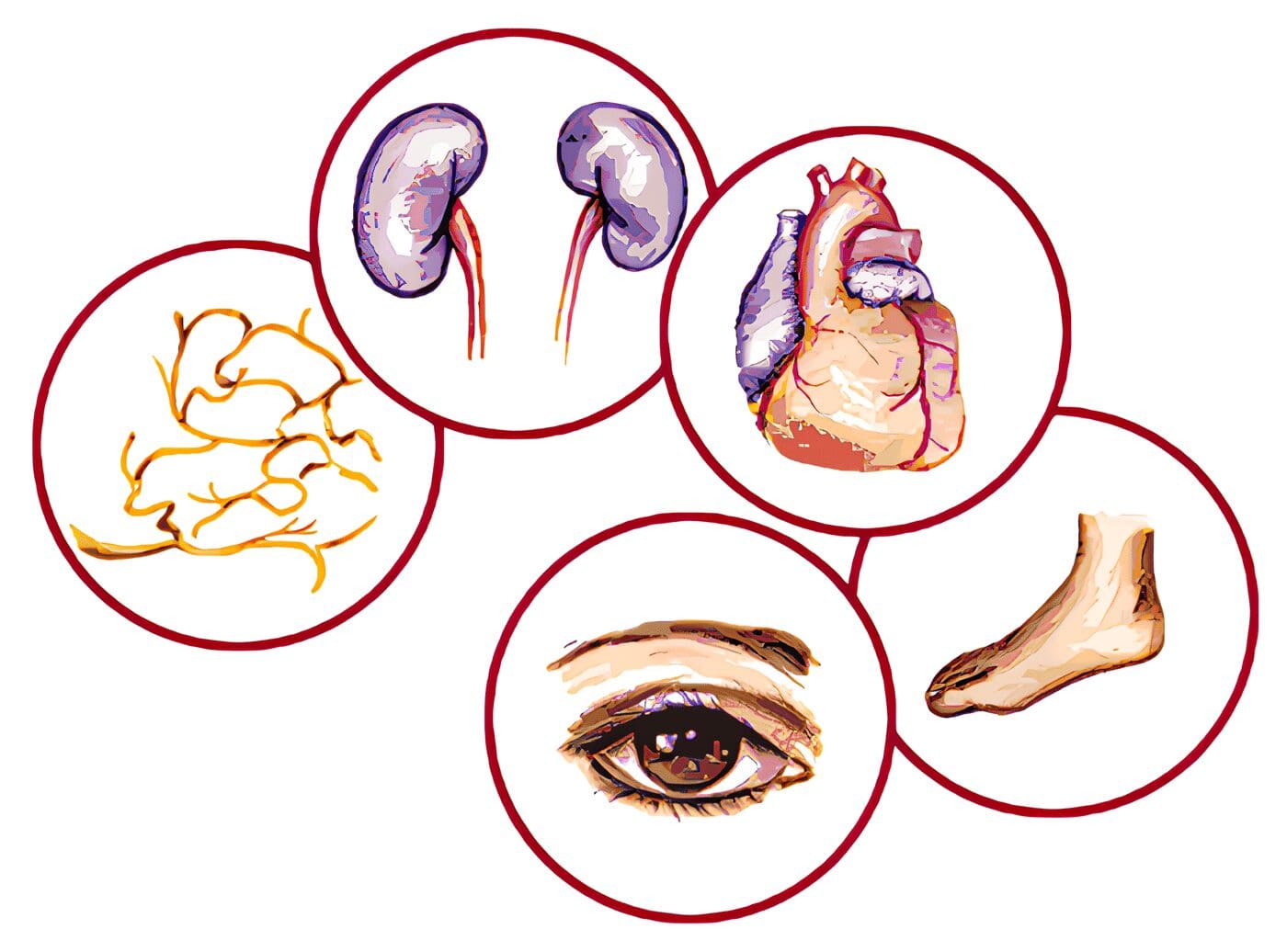 Complicaciones Micro Vasculares de la Diabetes