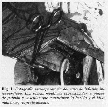 Infusión intracardíaca