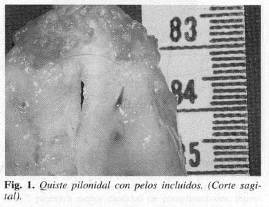 Quiste pi/onidal con pelos incluidos