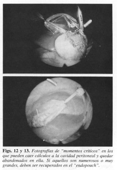 "Momentos Críticos" en los que pueden caer cálculos a la cavidad peritoneal