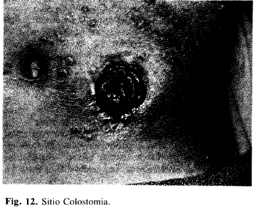 Sitio Colostomia