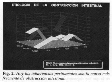 Adherencias peritoneales la causa más frecuente de obstrucción intestinal