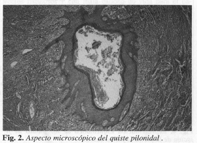 Aspecto microscópico del quiste pilonidal