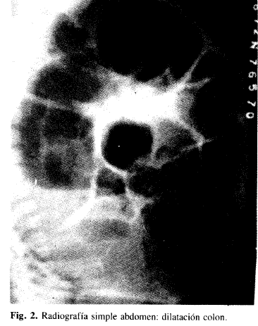 Radiografía simple abdomen: dilatación colon