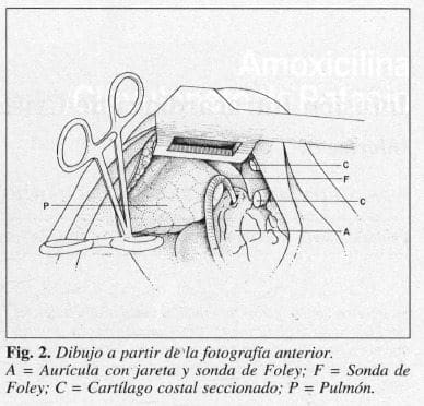 sonda de Foley