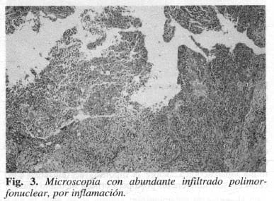 Microscopía con abundante infiltrado polimorfonuclear, por inflamación