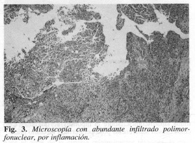 Microscopía con abundante infiltrado polimorfonuclear, por inflamación