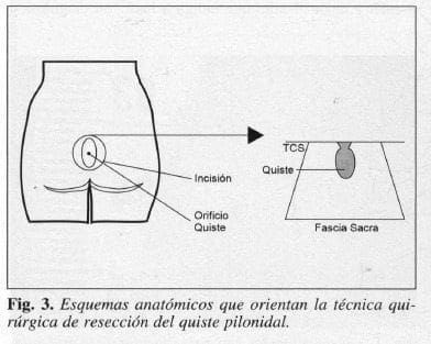 Esquemas anatómicos que orientan técnica quirúrgica resección quiste pilonidal