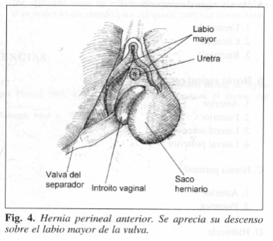 Hernia perineal anterior