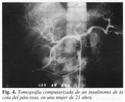 Tomografía computarizada de un insulinoma de la cola del páncreas