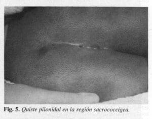 Quiste pilonidal en la región sacrococcígea