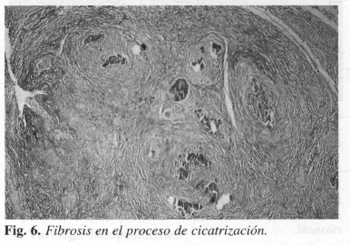 Fibrosis en el proceso de cicatrización