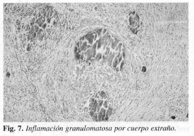 Inflamación granulomatosa por cuerpo extraño.