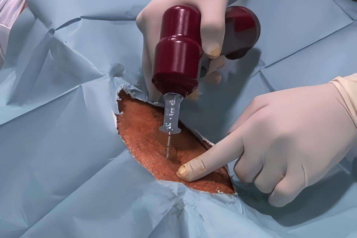 Infusión Intracardíaca de Cristaloides