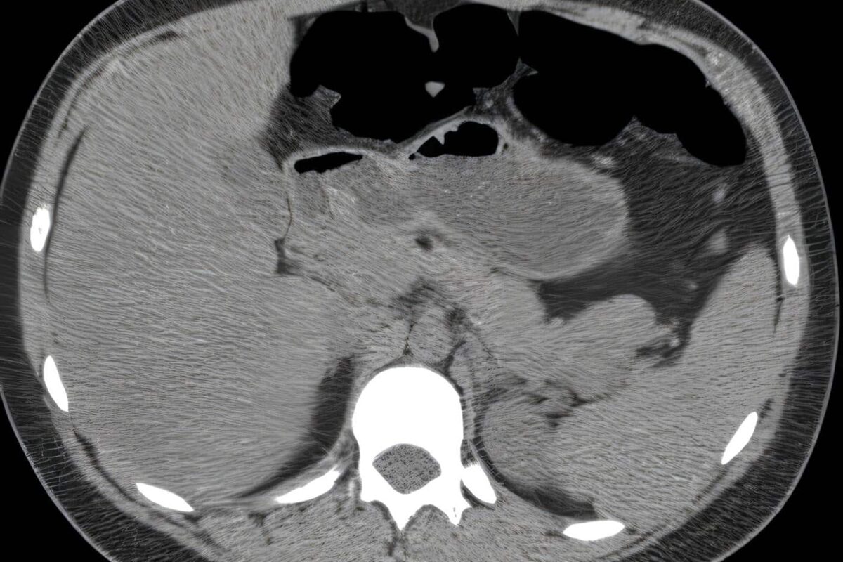 Revista de Cirugía: Insulinoma, Discusión