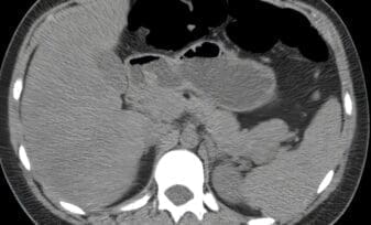 Revista de Cirugía: Insulinoma, Discusión