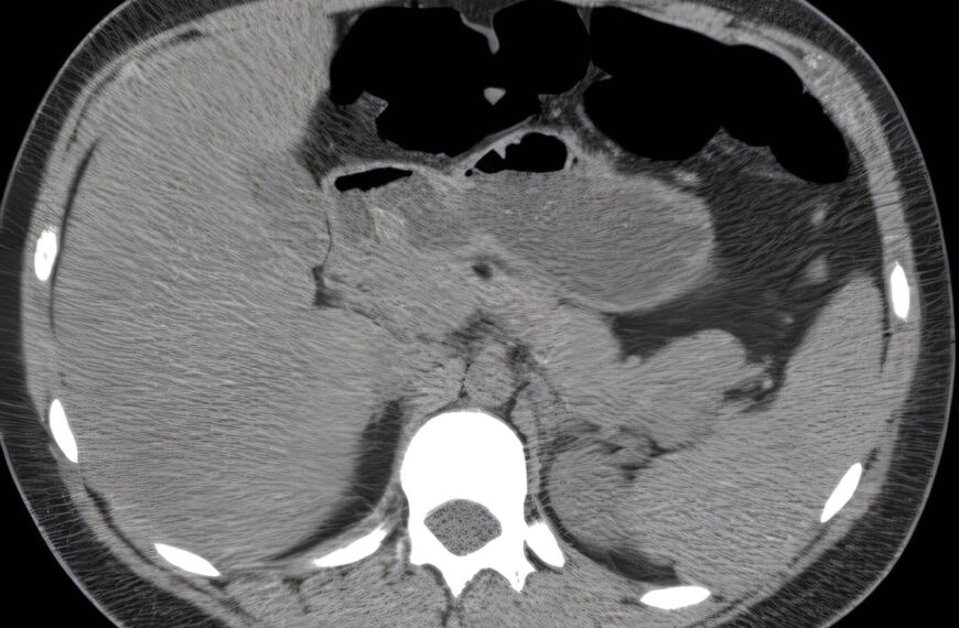 Revista de Cirugía: Insulinoma, Discusión