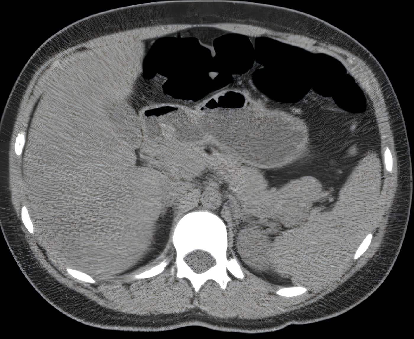 Revista de Cirugía: Insulinoma, Discusión