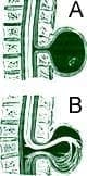 A) Meningocele B) Meningomieloradiculocele