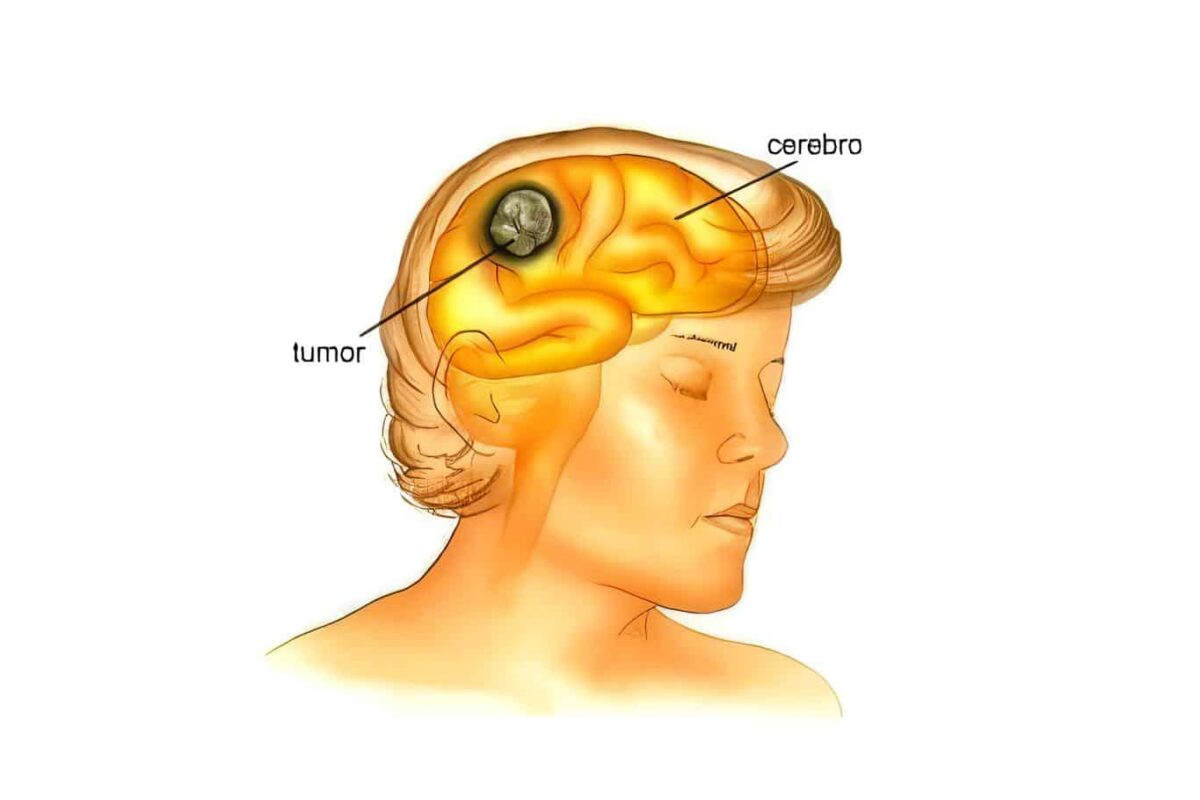 Tumores cerebrales